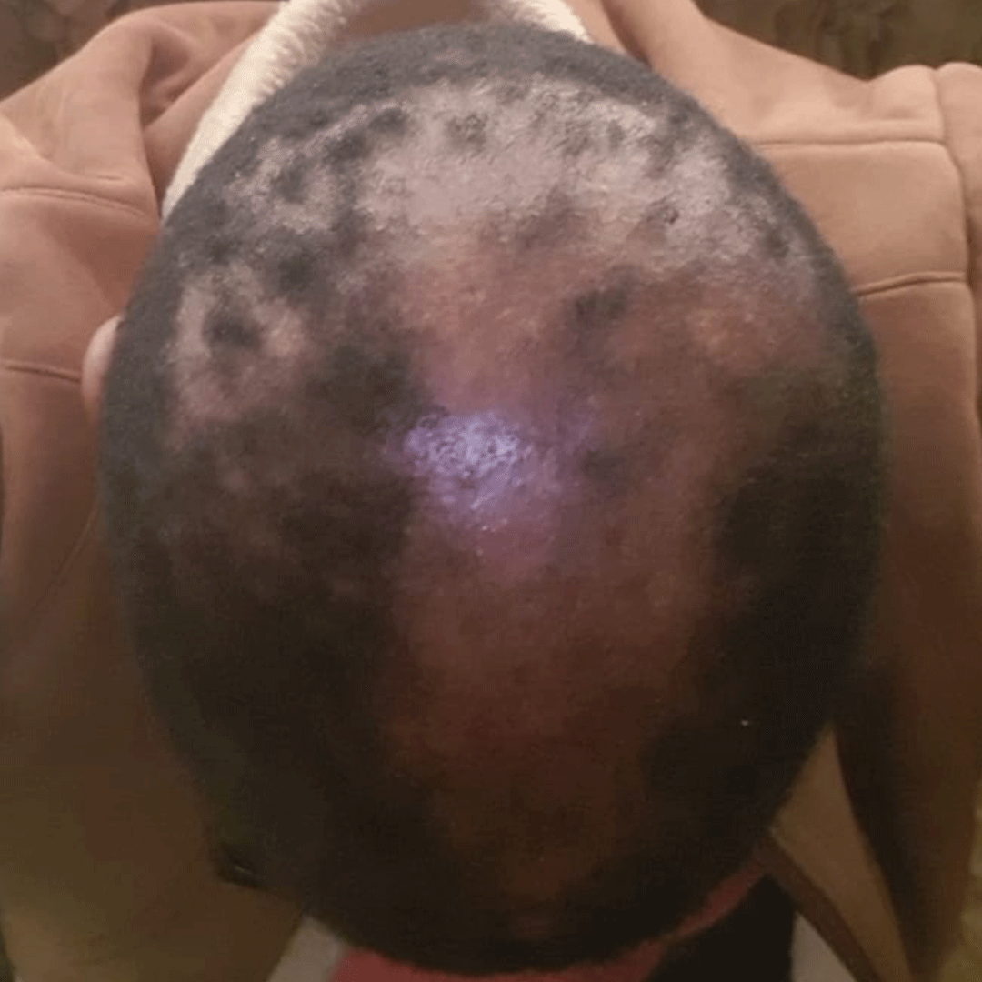 Hair-Transplant-Before